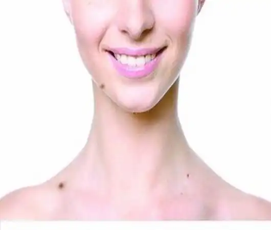 外阴色素痣怎么预防