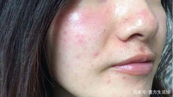 敏感肌百科(2300字)|5种敏感肌护理关键词及7大注意事项