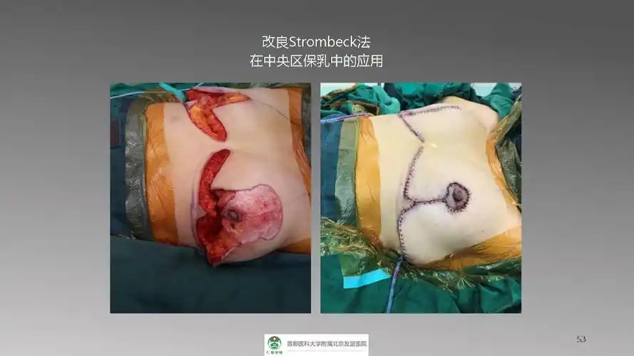 乳腺癌手术切口设计与技巧