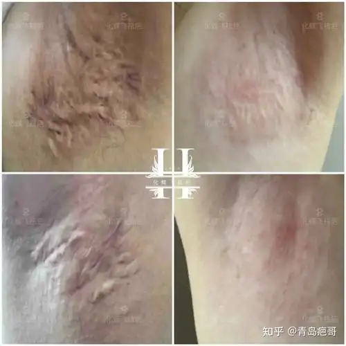 做腋下大汗腺切除手术是什么体验