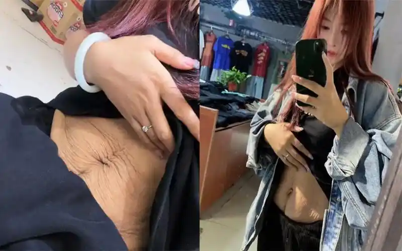 26岁宝妈晒剖腹产后的肚皮,松垮褶皱比脸大出20岁:怕一辈子这样