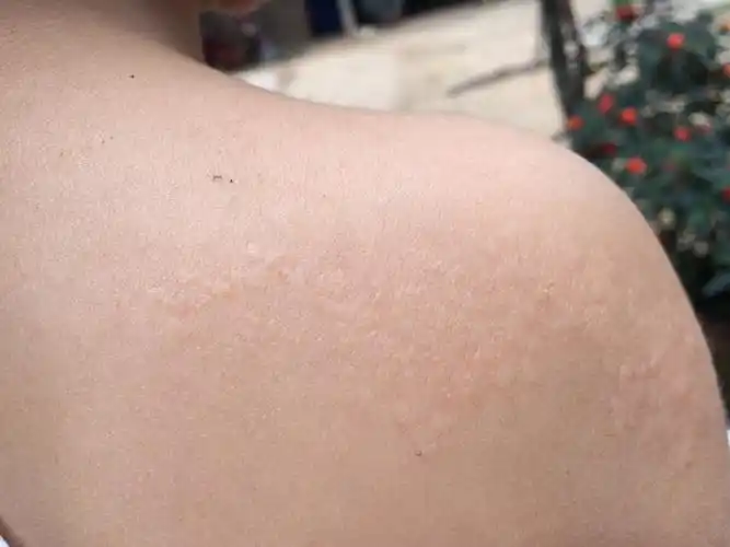 宝宝小鸡上长了块癣 宝宝蛋蛋上有红色的癣-图片大观-奇异网