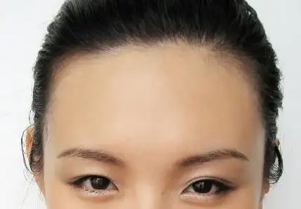 激光发际线脱毛让五官更协调