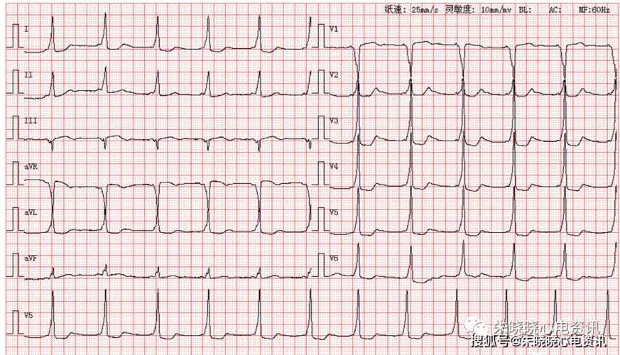 患者女,30岁,图为其产检心电图