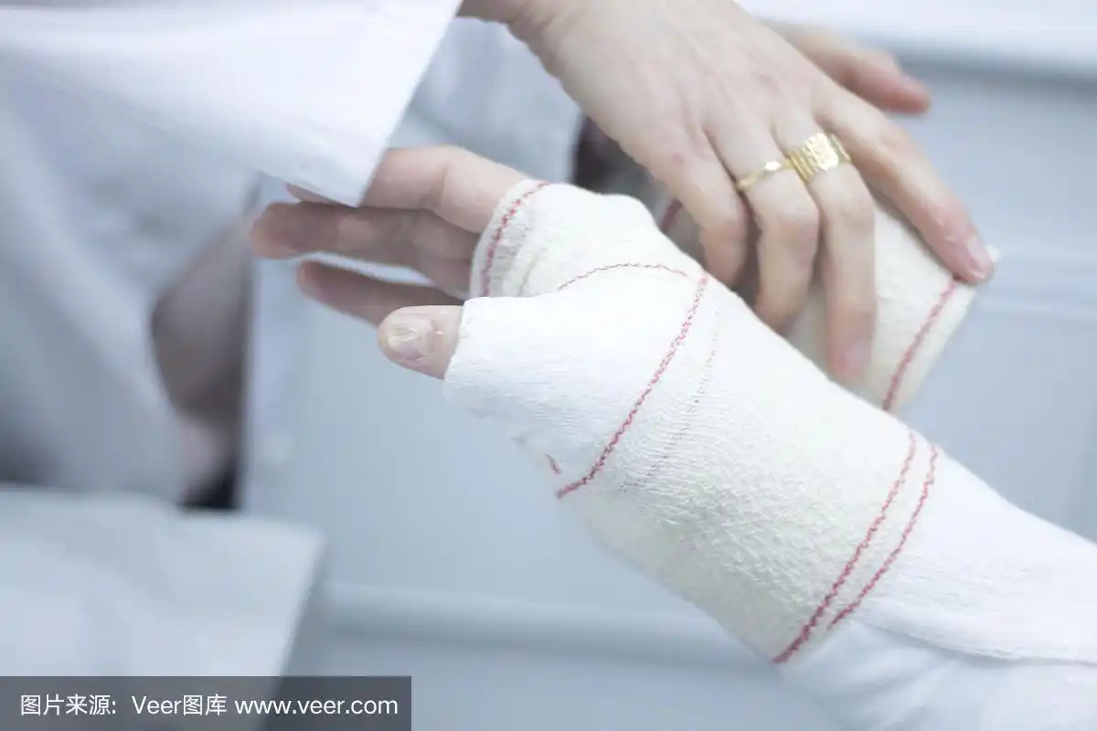骨折后,医生在患者前臂和手腕上使用石膏石膏和绷带固定.