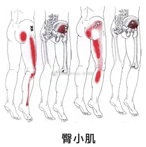 臀小肌损伤臀小肌位于臀中肌深层,损伤. 来自kingarthur阿瑟王 - 微博