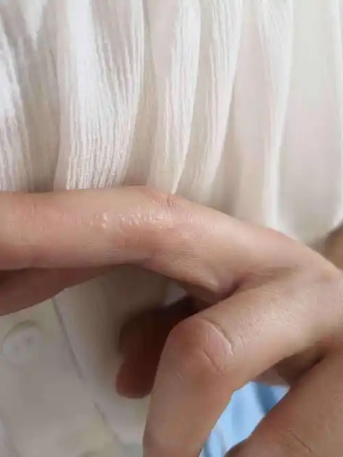 深圳市宝安区中医院 皮肤科根据你描述的情况,考虑是汗疱疹,属于皮肤