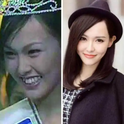 唐嫣的整牙历程,一口龅牙原来是这样一点点变齐的!