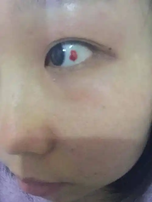 眼白的地方出现一块血块