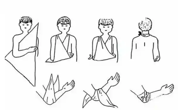 ②小悬臂带将三角巾折达成带状吊起前臂的前部(不要托肘部),适用于肩