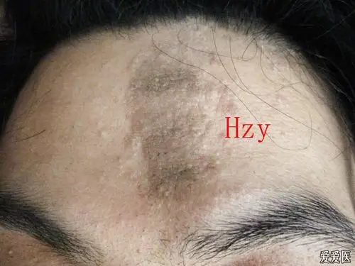 看图诊病---------表皮痣