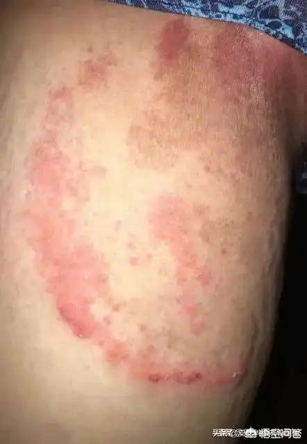 大腿内侧股癣怎么治治疗大腿内侧股癣用什么药