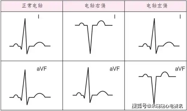 心电图解读的9个步骤和要点