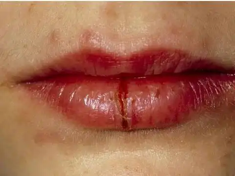 梦见嘴唇裂开