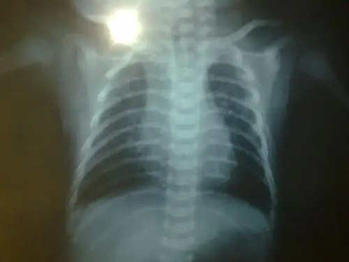 问题:20天宝宝在医院影像科诊断上写的是 支气管肺炎 该怎么办