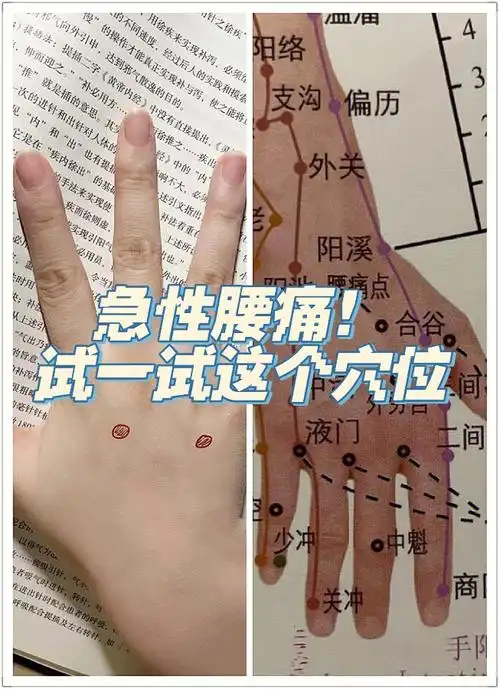 针灸  #腰痛  #急性腰扭伤