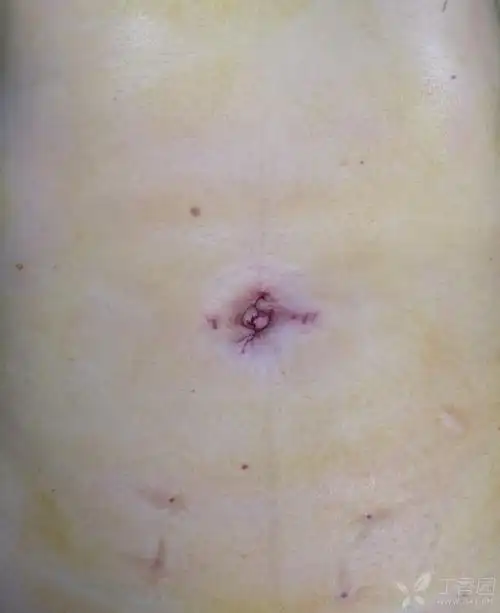 免气腹单孔腹腔镜全子宫切除术简易装置设计