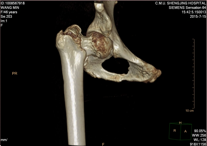 骨科科室play#右股骨粗隆间骨折evans 3型