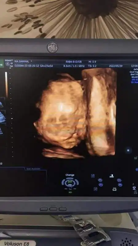 为孕妇敲警钟,"二胎"忽视产检,孕晚期却查出胎儿唇腭裂|彩超|手术