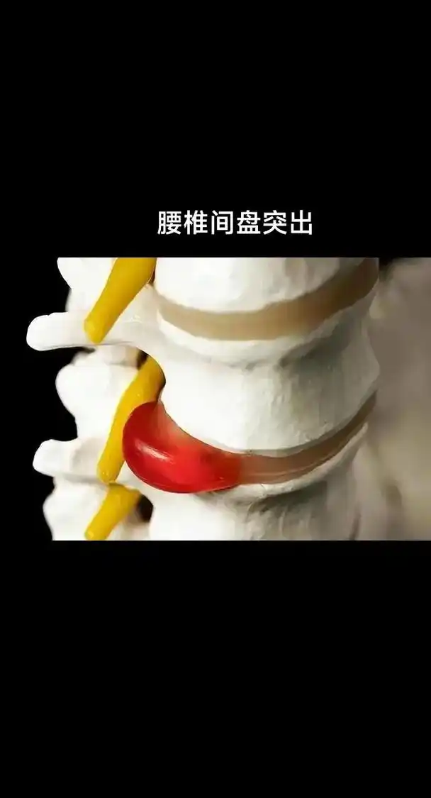 腰椎间盘突出症