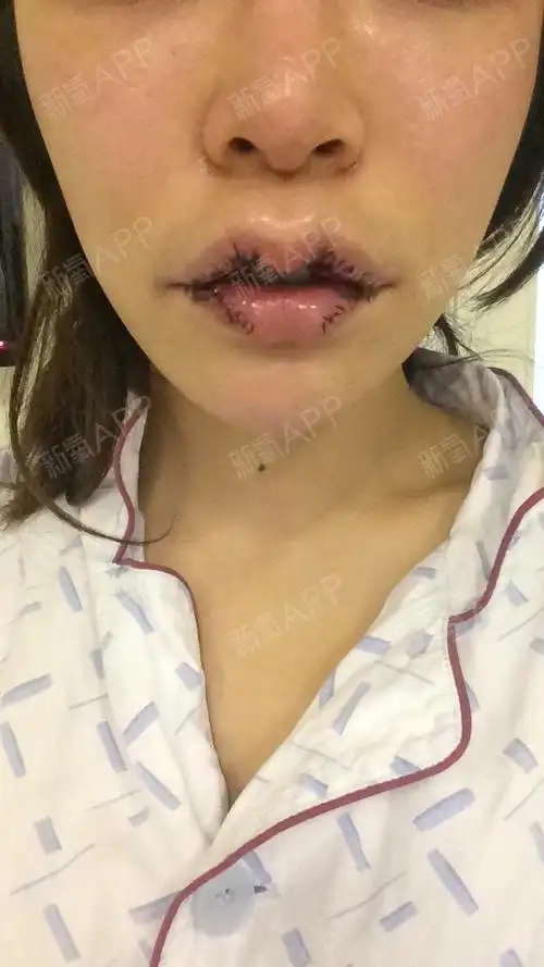 厚唇改薄术术后第1天