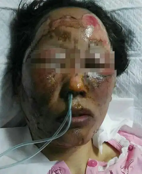 眉山女子出门被亲家泼汽油烧脸,用火砖拍头. - 知乎