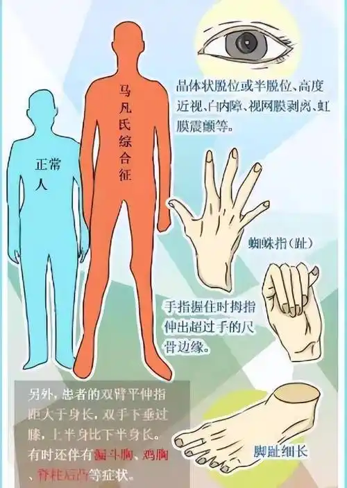 4岁娃患马凡综合征 双眼晶状体脱位_安安_冷非_手术