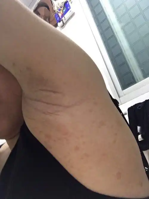 腋下长斑点,有同样情况的孕妈妈吗?