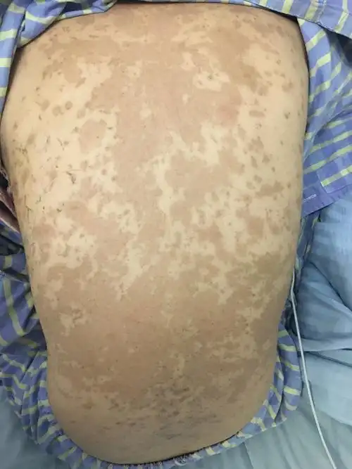 类似狼疮皮肤血管炎的干燥综合征患者 - 好大夫在线