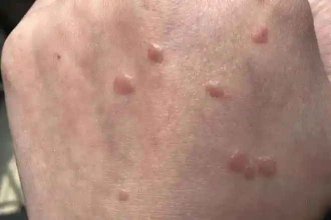 红点的出现会随着时间变生长变大,比如长出形似菜花状,乳头状的疣体