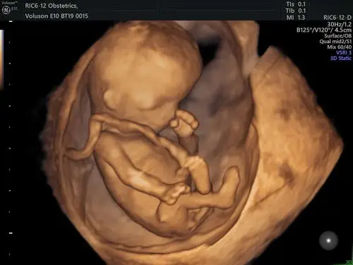 想见宝宝不用慌,四维彩超帮您忙-ge e10高端妇产彩超仪落户宁夏三院