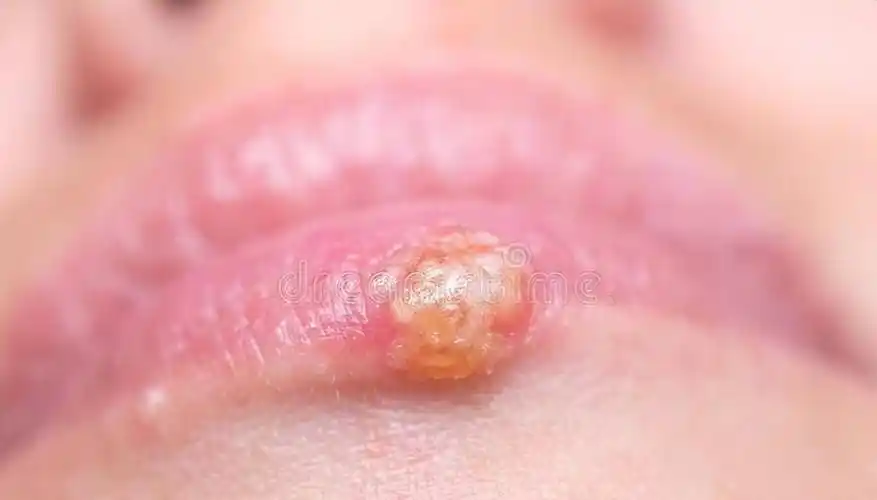 提醒:有3个皮肤异常,艾滋病的报案信号_症状_消息_袁晓