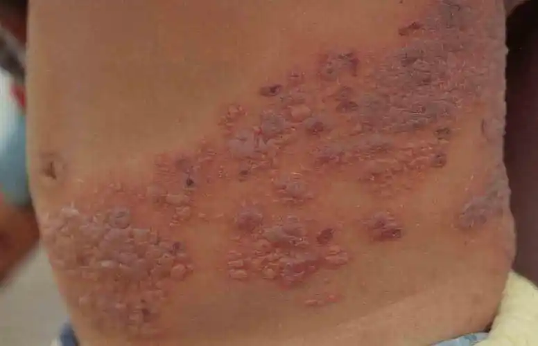 "蛇缠腰"长满一圈真的会死吗?