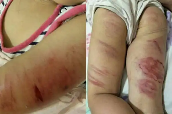 4岁女童遭狠父烤肉夹虐打布血痕 网怒:下次还能救到吗?