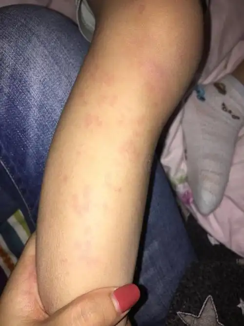 宝宝全身发风疹块了,原因不只是过敏噢-黄剑峰副主任医师-爱问医生