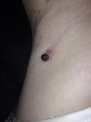 问:胳肢窝好几年前长了个疙瘩,以前不疼不痒,,今年