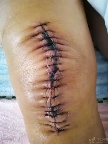 膝关节置换术后一个月,伤口近端结痂,少量渗出 [病例帖]