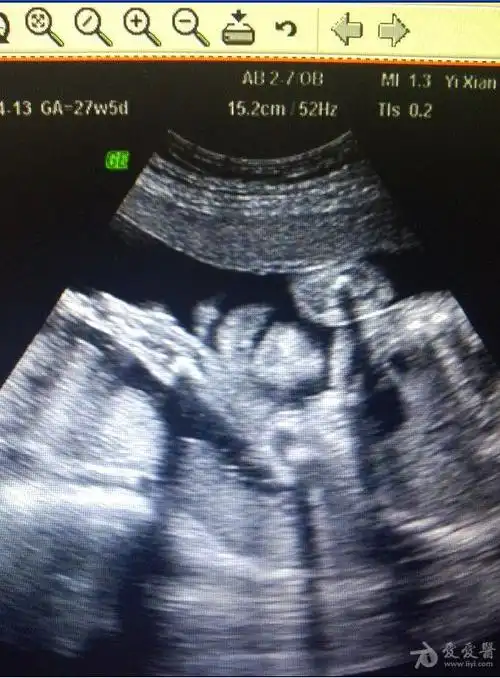 请大家帮看看,这个胎儿的嘴有病吗?