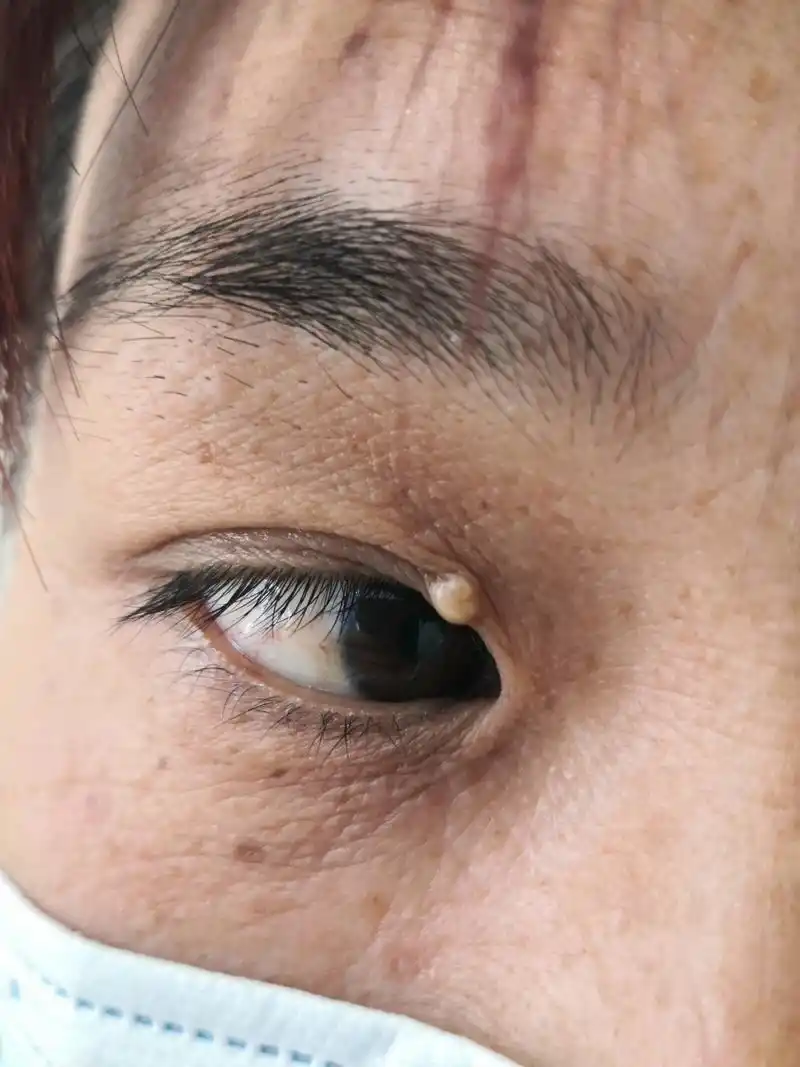 眼睑边缘的粟丘疹症状#美容# 可以使用激光治疗去除.
