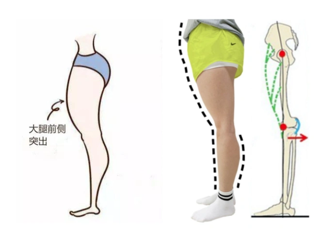 徐璐漫画腿绝美,为什么你的大腿前侧异常发达?