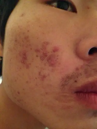 问:脸上长暗疮是怎么回事,怎么治疗呢