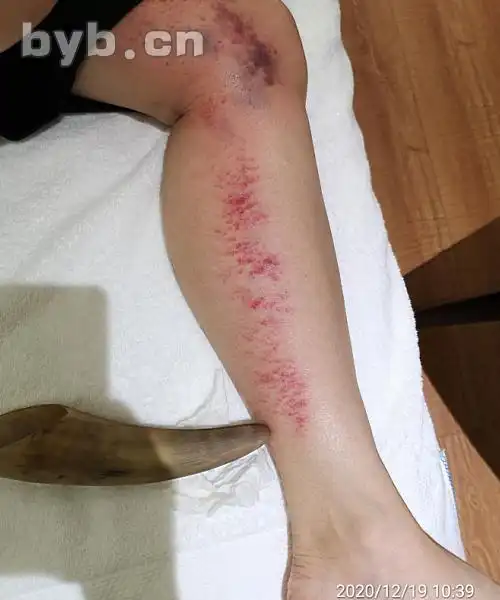 左小腿内侧脾经刮痧