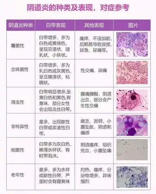 阴道炎种类及表现,对症参考_盐城_症状_概念
