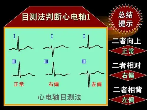 心电轴心电轴右偏