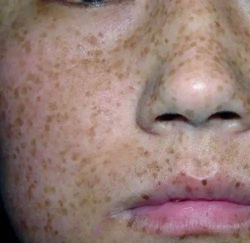 斑点太多成麻子脸,可能是黑色素疯狂繁殖,试试古时1种淡斑粉_凤凰网