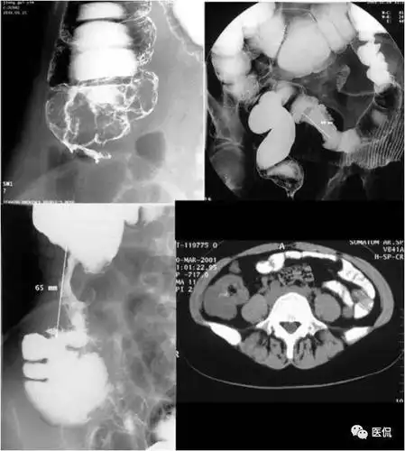 僵硬为特征溃疡型:龛影大多成多角形;周围有清楚的环堤;周围皱襞中断
