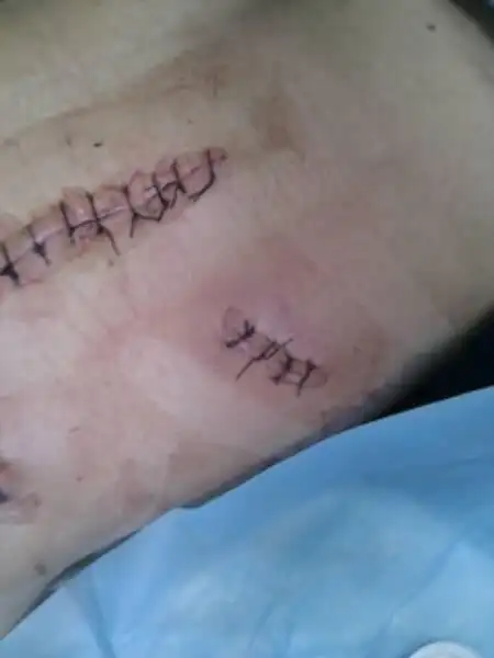 肋间刀伤5cm左右,腹壁穿通,大网膜脱出并嵌顿,肋间动脉血管断裂.