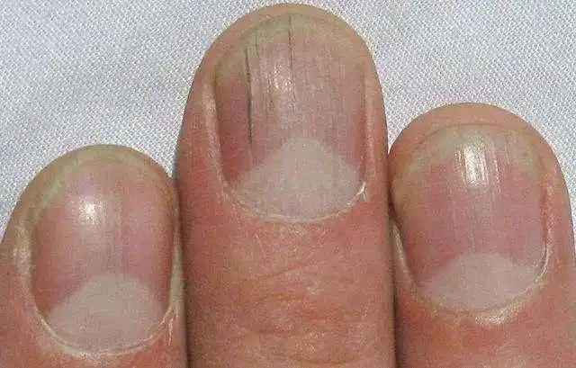 肝不好的人,指甲会有3种"丑相",做到"2少2多",保护肝脏