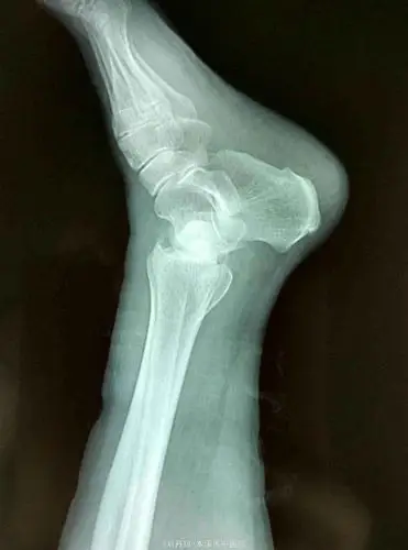 左踝关节骨折