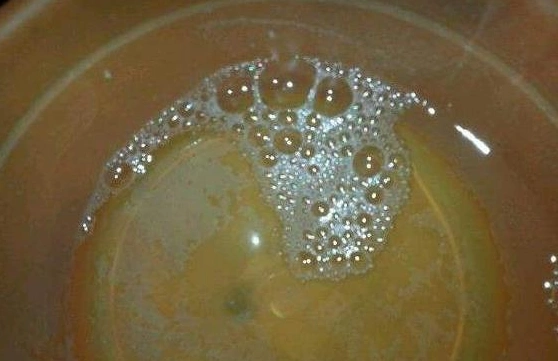 尿中有泡沫是怎么回事呢